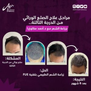 علاج تساقط الشعر للرجال – علاج الصلع – تساقط الشعر وعلاجه