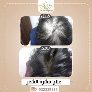علاج تساقط الشعر والصلع الدهني الشديد